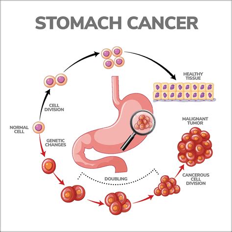 melanoma spread to stomach