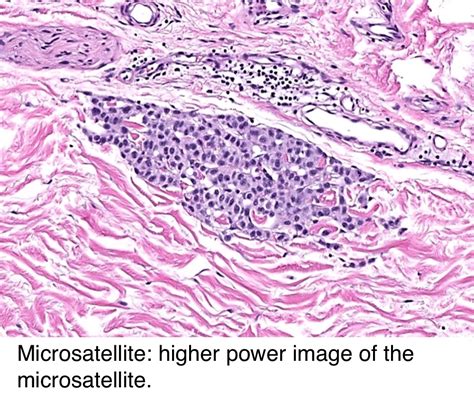 melanoma staging pathology outlines