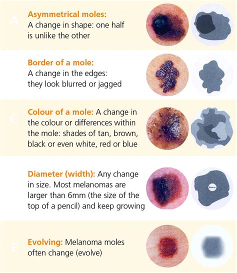 melanoma symptoms in children