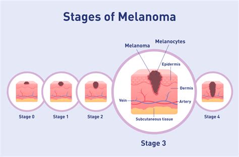 melanoma symptoms stage 3