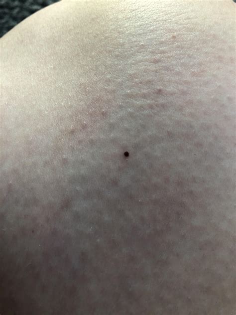 melanoma tiny black dots on skin