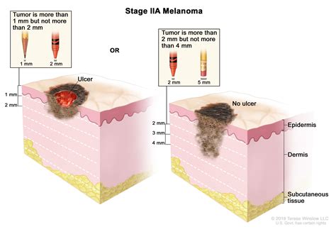 melanoma treatments prognosis