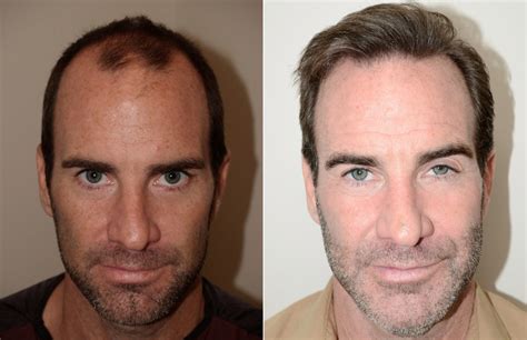 25 year old Male Hairline Restoration Carolina Hair Surgery