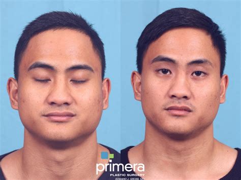 men buccal fat removal