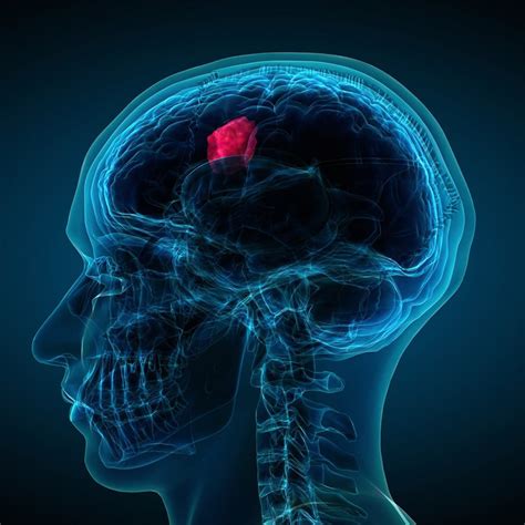 meningioma brain tumor near brain stem