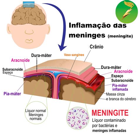 meningite causada por
