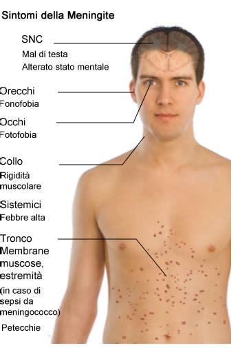 meningite da meningococco sintomi