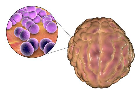 meningitis caused by bacteria