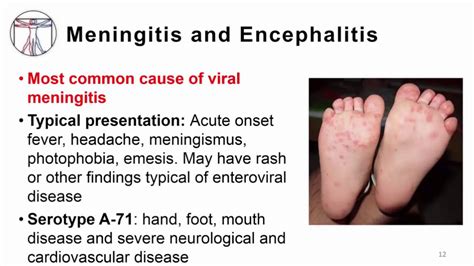 meningitis caused by enterovirus