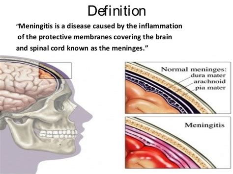 meningitis definition medical terminology