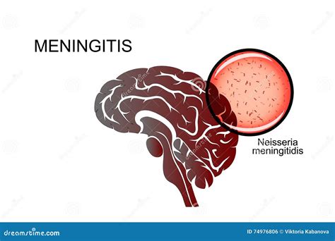 meningitis in the brain