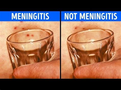 meningitis rash baby glass test
