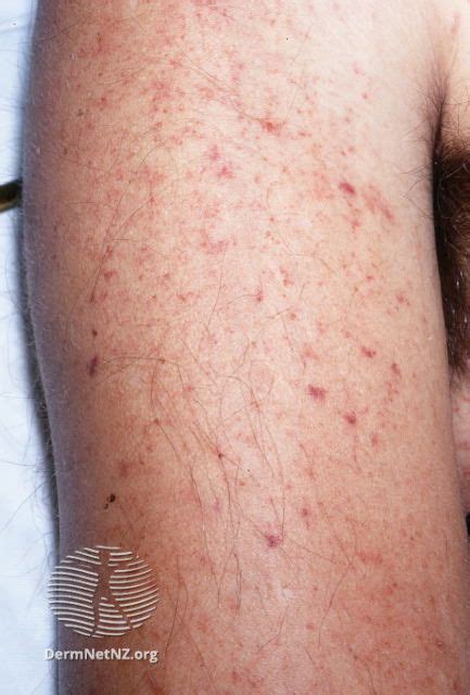 meningitis rash blanching