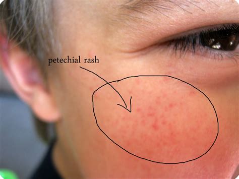 meningitis rash on face