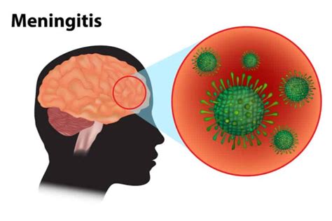Meningitis Vaccine Side Effects Eyes TRENDND