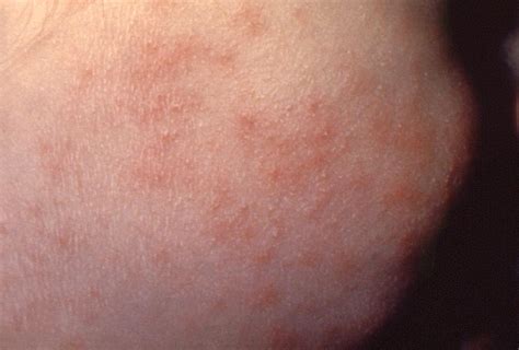 meningitis skin rash images