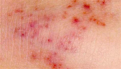 meningococcal meningitis skin rash