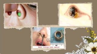 Menjebak Benda Asing