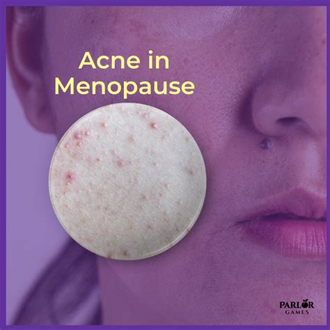 Menopause Acne Mumsnet