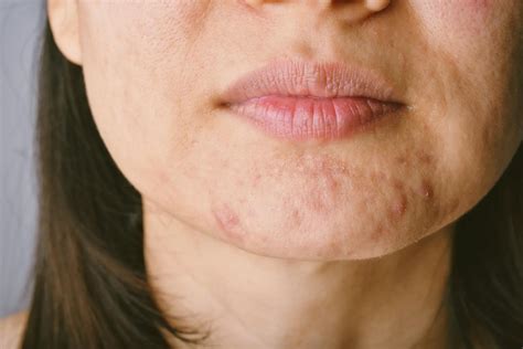 Menopause And Face Breakouts