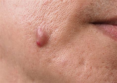 Menopause Facial Cysts