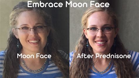 Menopause Moon Face