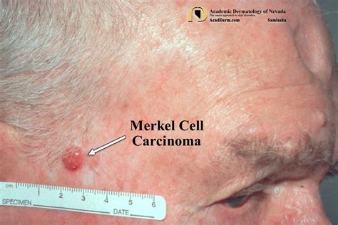 merkel cell ca