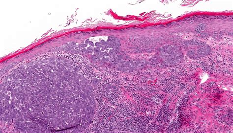 merkel cell carcinoma histology images