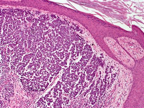 merkel cell carcinoma histology images