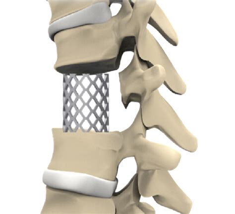 Mesh Cage Spine