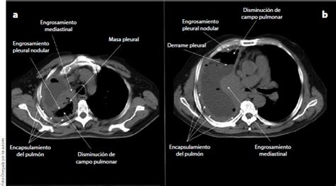 mesotelioma pleural tomografia