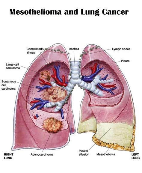 mesotelioma polmonare