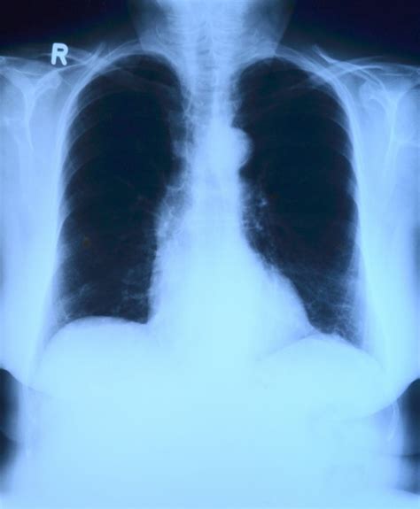 mesotelioma pulmonar