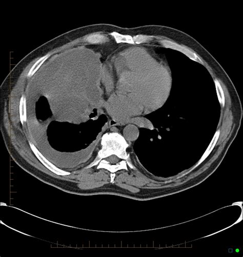 Mesothelioma Radiology Ct Ct For Detection Of Malignant Posterior