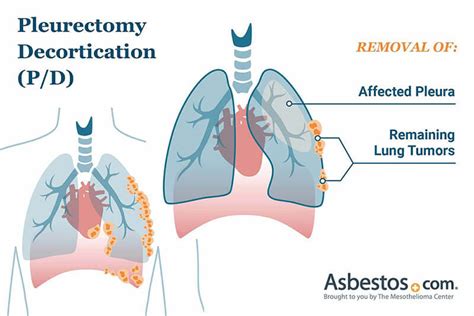 mesothelioma cure for pleural