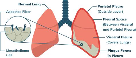 mesothelioma of pleura definition