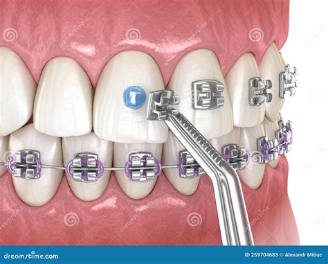 Metal Braces Process