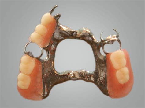 Metal Casting Denture