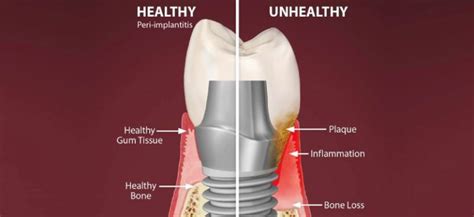 Metal Dental Implants Side Effects