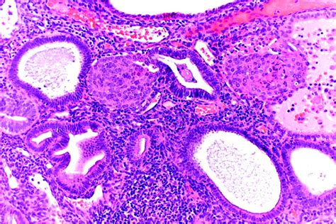 metaplasia endometrium pathology outlines