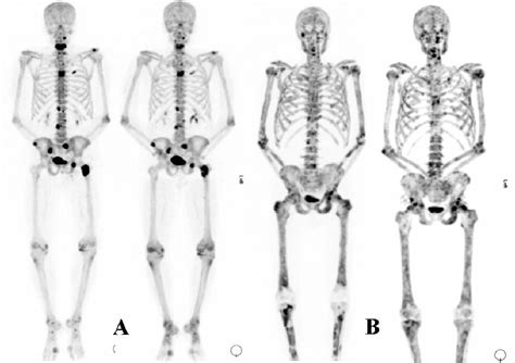 metastatic bone disease life expectancy