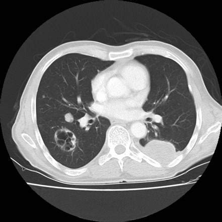 metastatic melanoma lung treatment