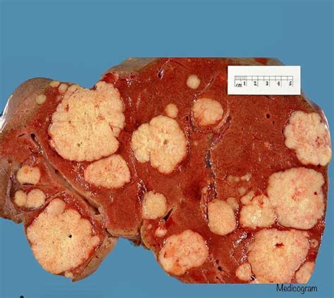 metastatic melanoma of the liver