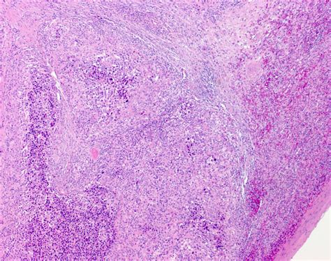 metastatic melanoma pathology outlines
