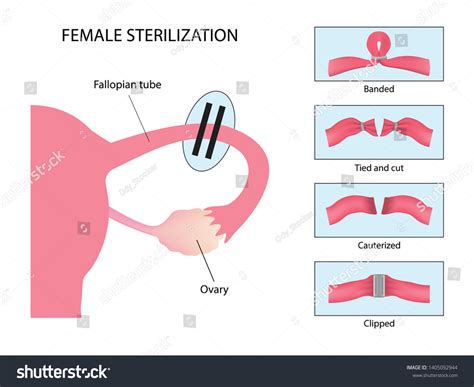 Methods Of Sterilization Female