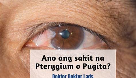 Ano ang sakit na pterygium o pugita? - TRENDING PORTAL