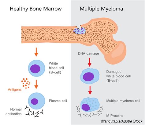 mgus and abnormal blood protein levels