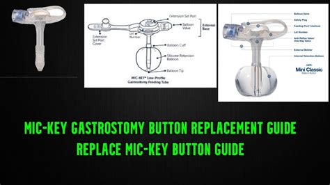 Mic-Key Button Replacement Cpt Code