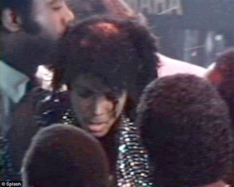 michael jackson's hair caught on fire in 1984