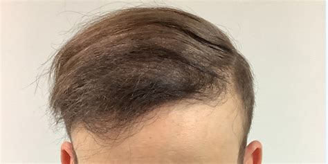 For Men Before and After 39 Michigan Hair Restoration